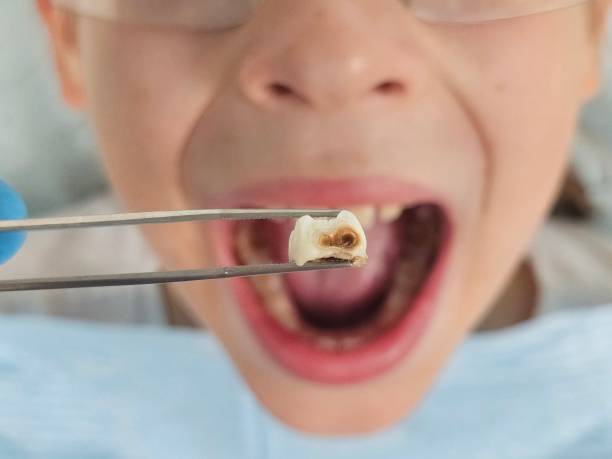 Best Emergency Tooth Extraction in Lebanon, OR